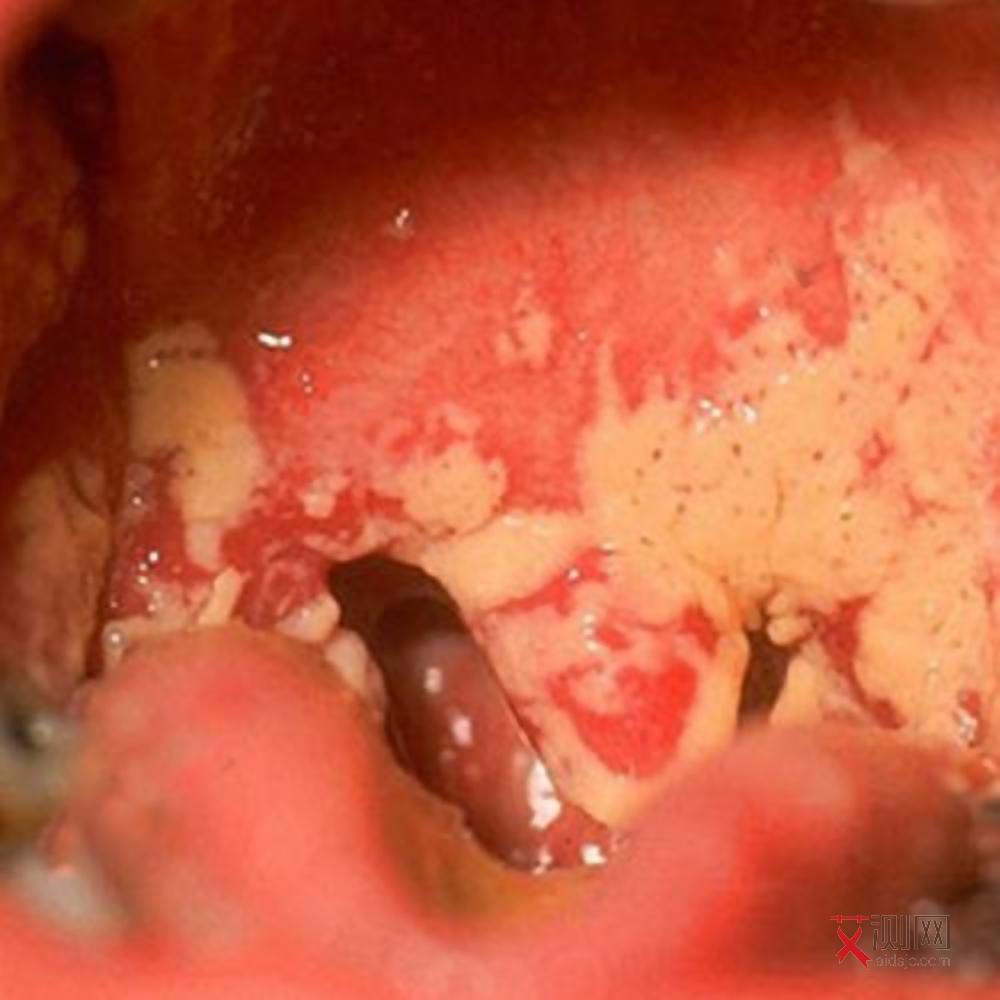 艾滋病身上起疙瘩图片怎样预防艾滋病传染