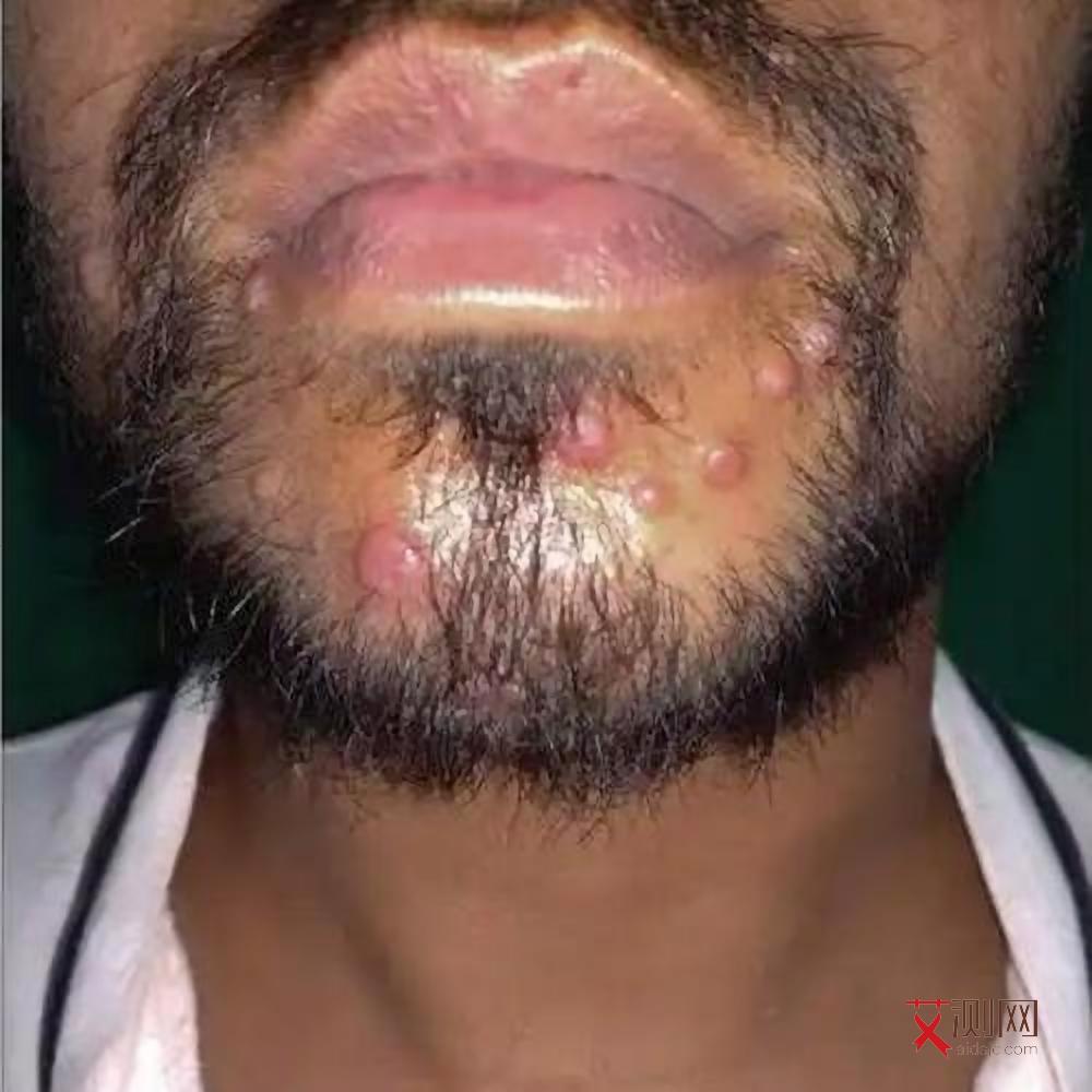 艾滋病皮肤破溃图片大全