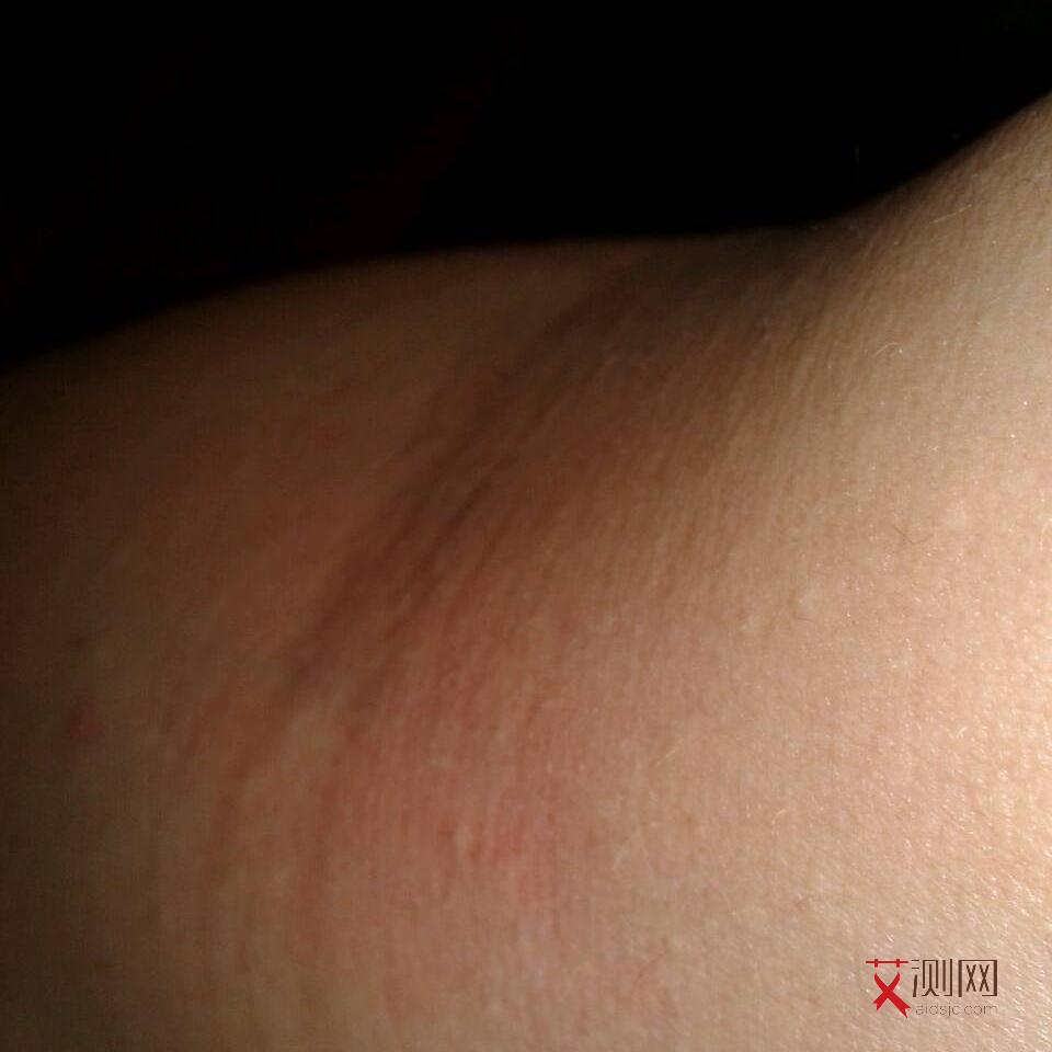 艾滋病初期症状有哪些症状图片大全男性