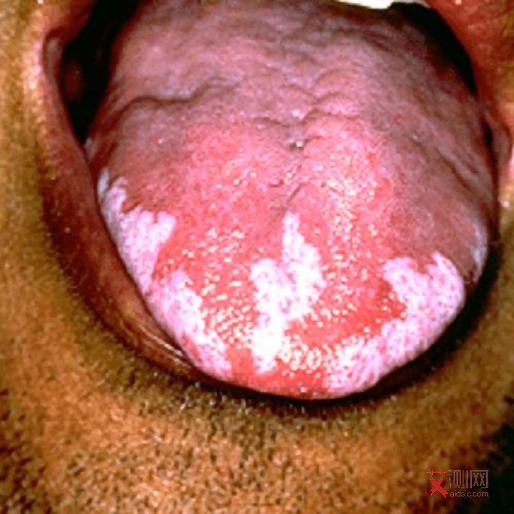 艾滋病发病期身上长红点是什么样的