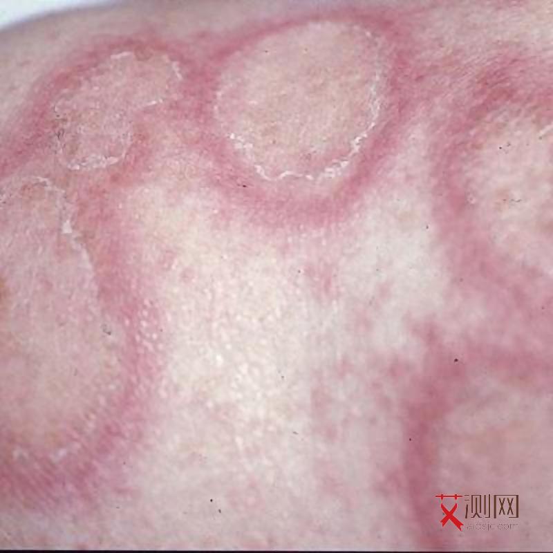 艾滋病初期皮疹是怎样的？