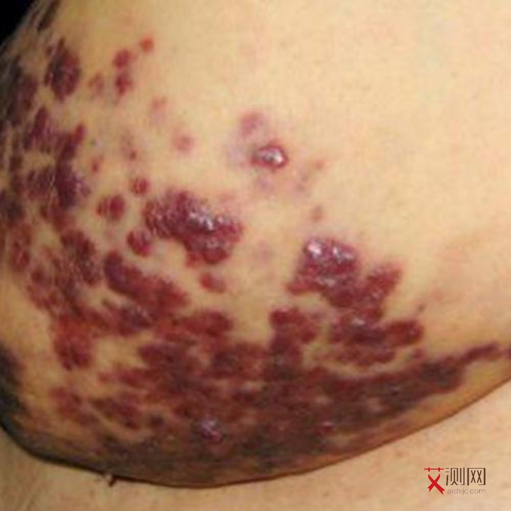 艾滋病唾液能传染么