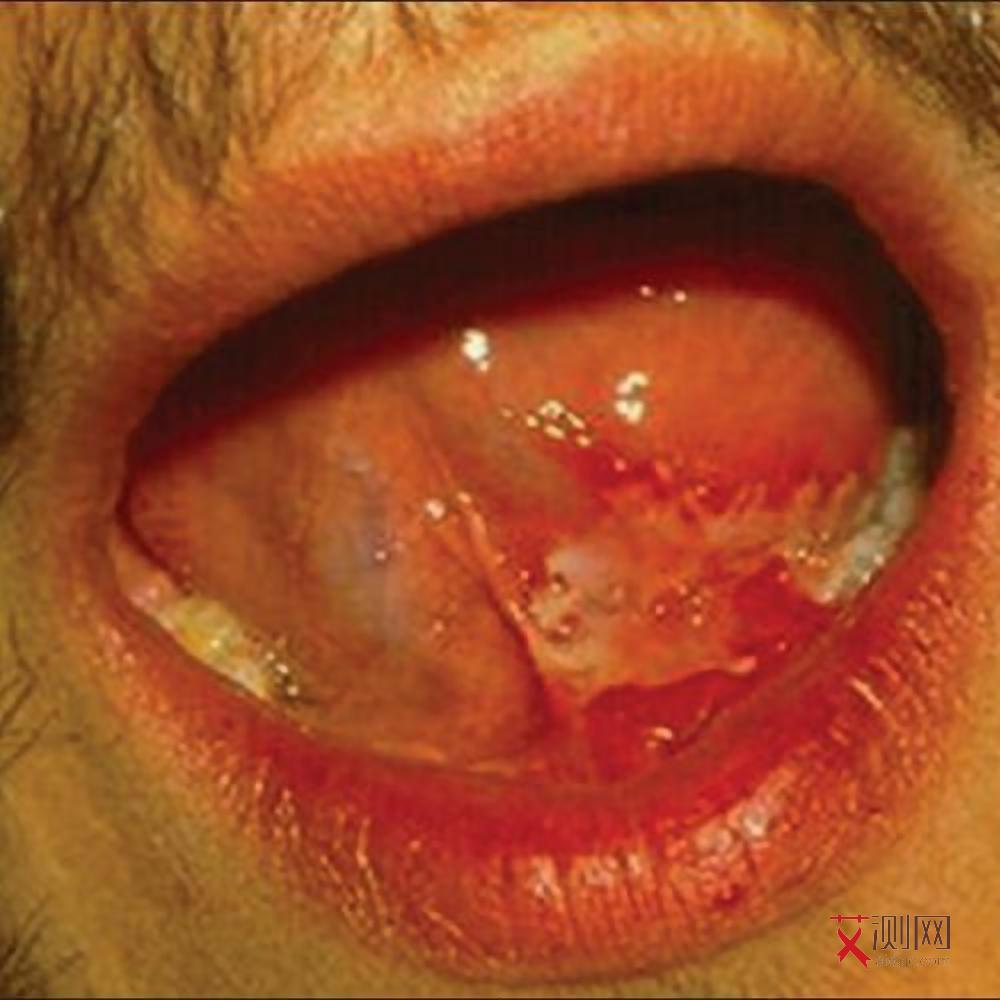 艾滋病女性症状图片真实高清大图大全