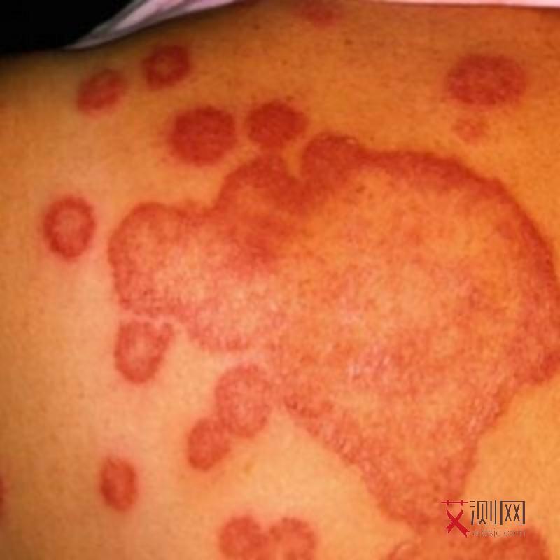 感染艾滋病男人会有什么特征呢