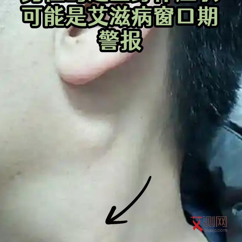 艾滋病晚期是什么时候开始的