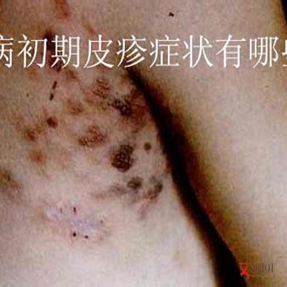 艾滋病会出现女性生殖器,出血吗女性