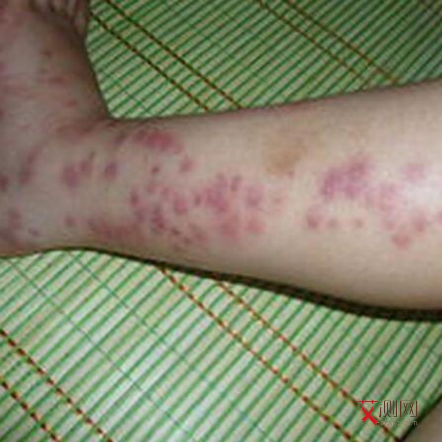 艾滋病小红点早期图片大全图解女性症状