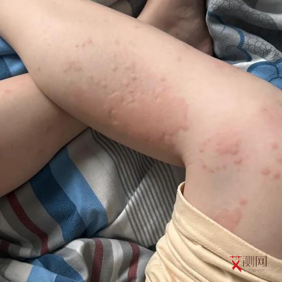 艾滋病传播途径和预防措施