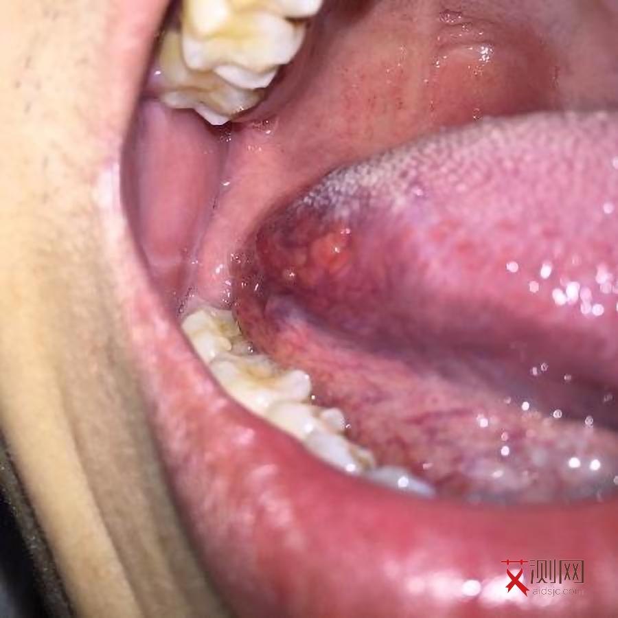 天津市艾滋病阻断药哪里有