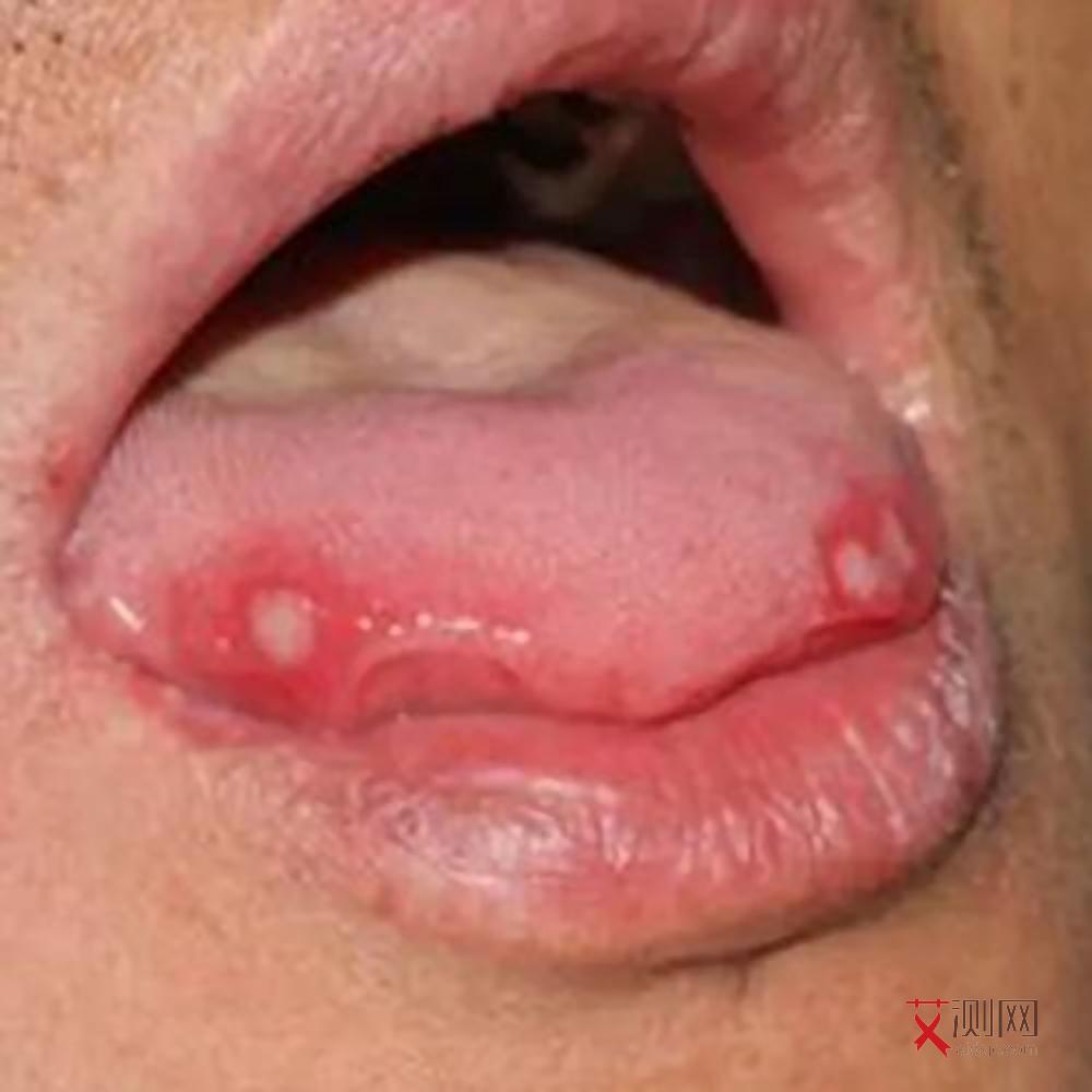 艾滋病多久有临床表现出现症状