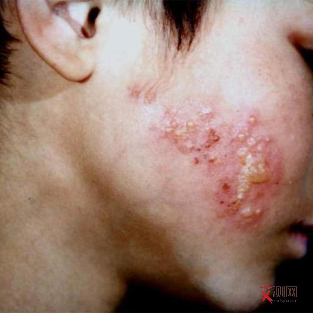 艾滋病初期身上的红点几天就没了正常吗图片