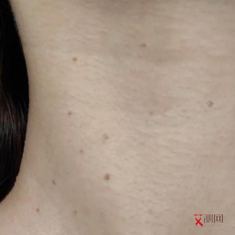 艾滋病多久发作症状