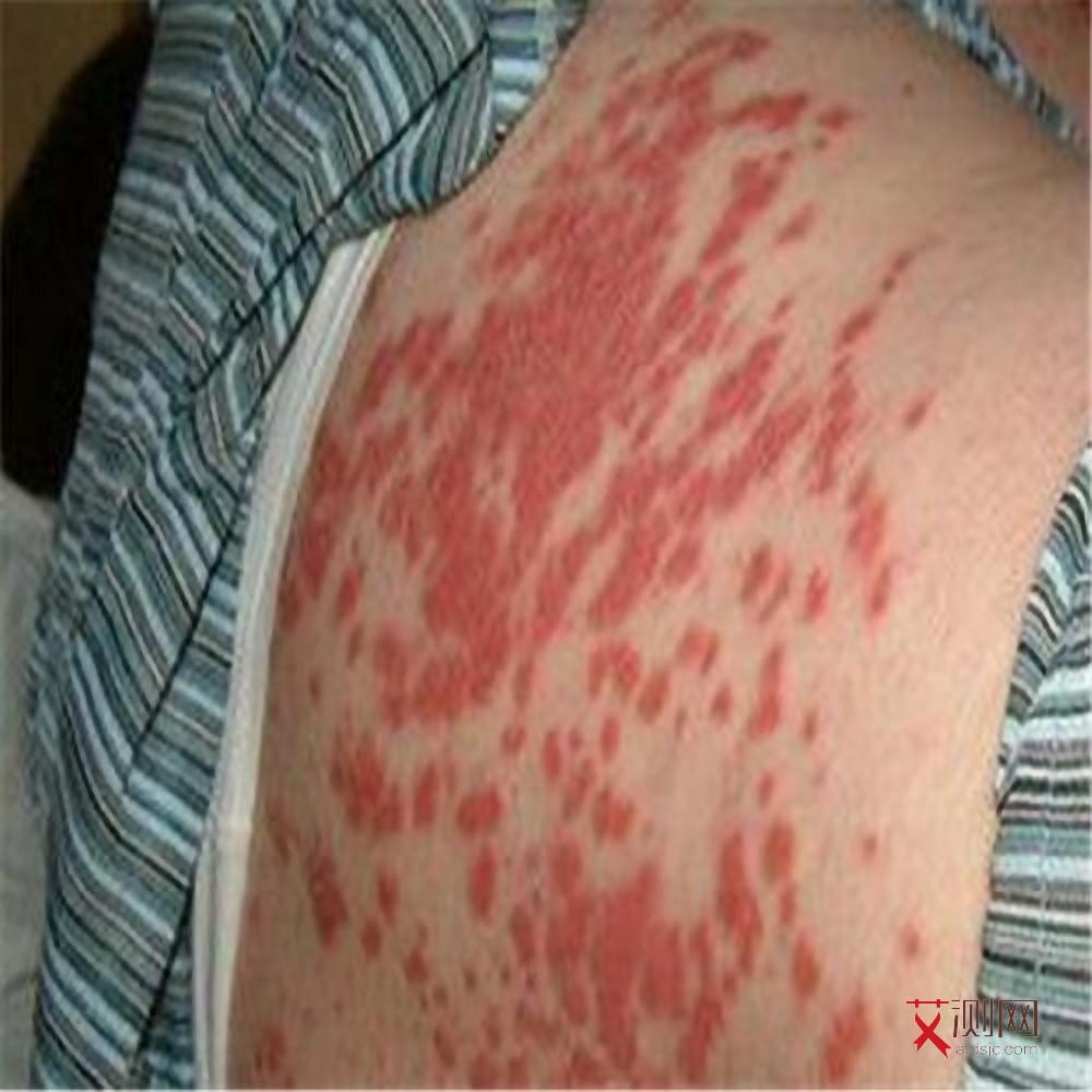 艾滋病女性症状图片真实高清大图大全