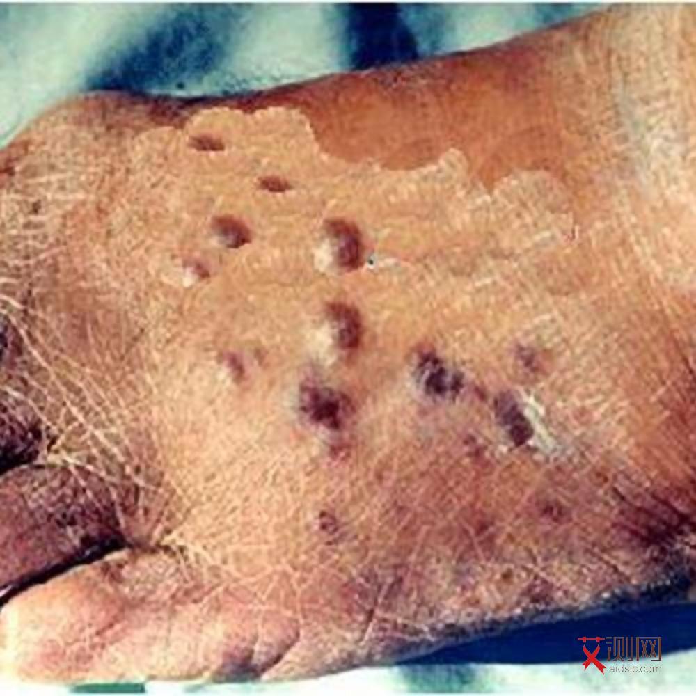 艾滋发烧症状有哪些