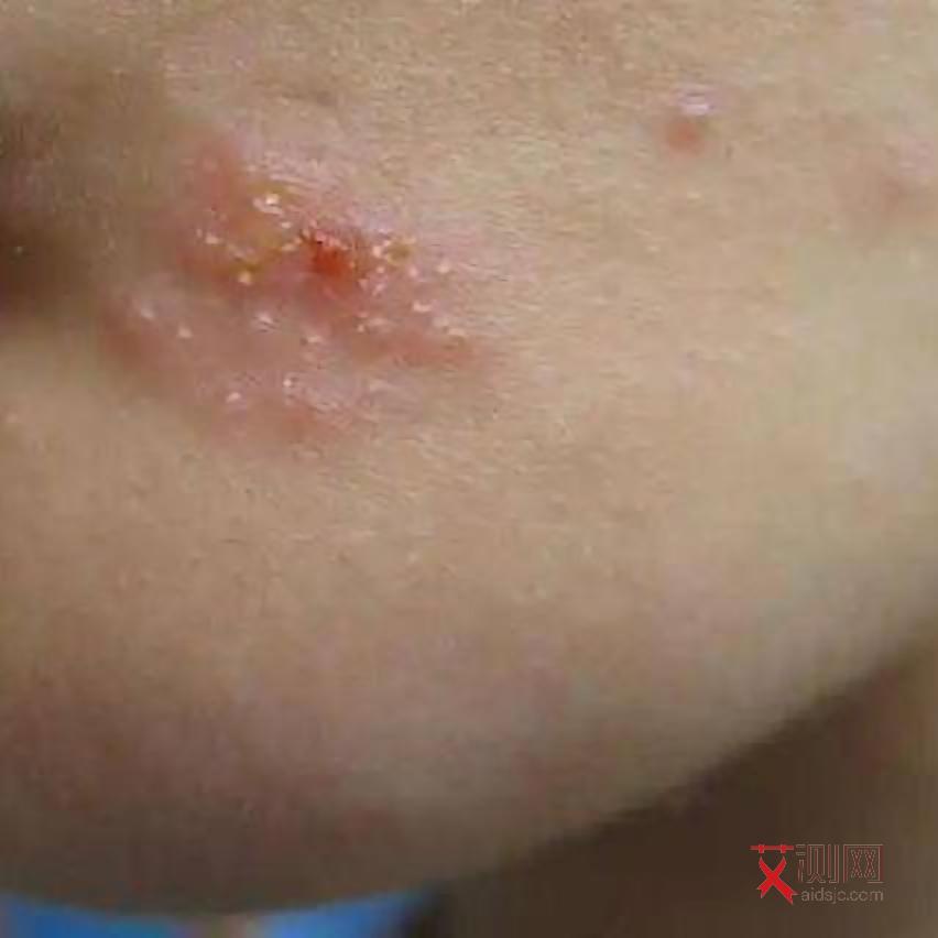 艾滋征兆多久会出现皮疹