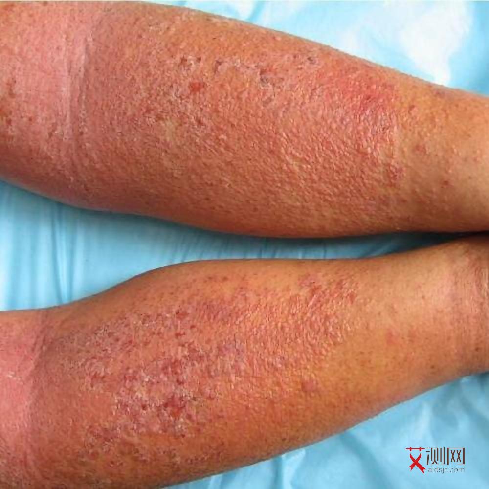 女性艾滋病皮疹特点图片大全高清