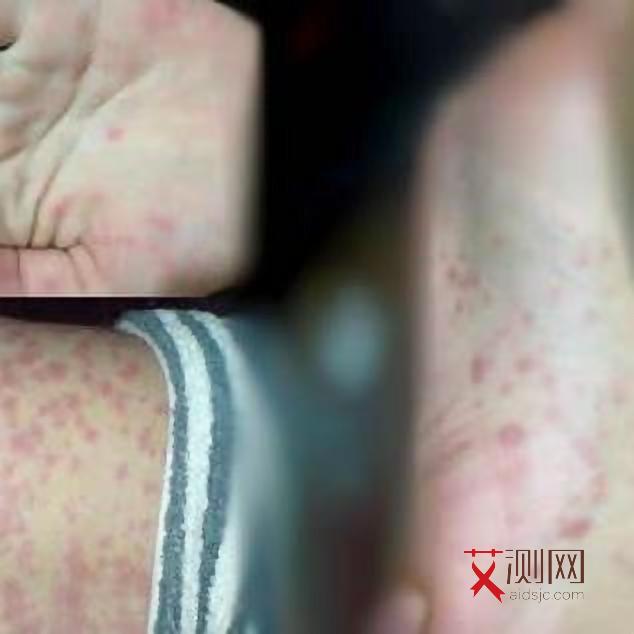 天津查艾滋病医院在哪查