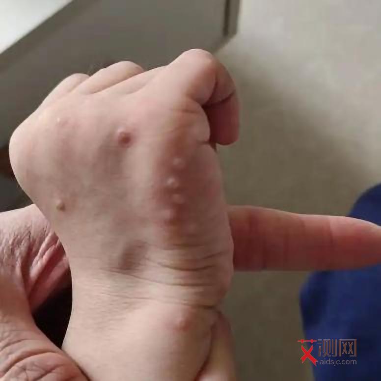 男生如何判断艾滋病患者女性性别