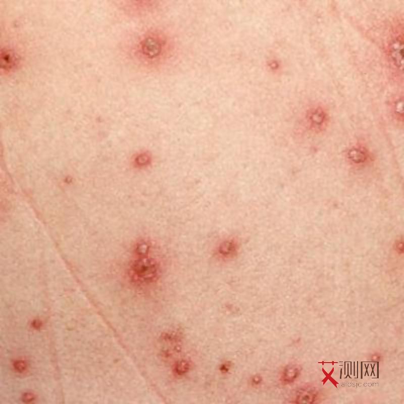 初期艾滋病皮肤病图片大全真实
