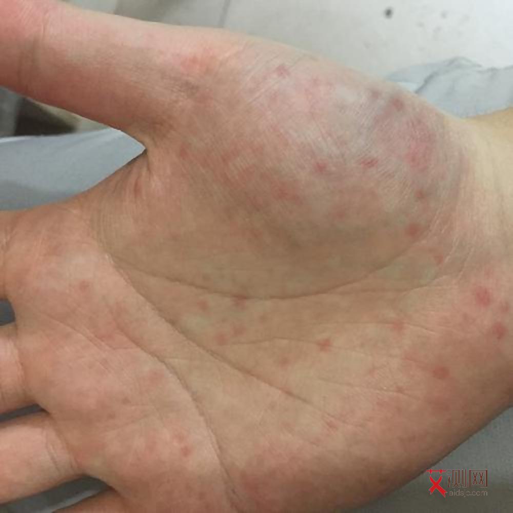 被小姐传染艾滋病