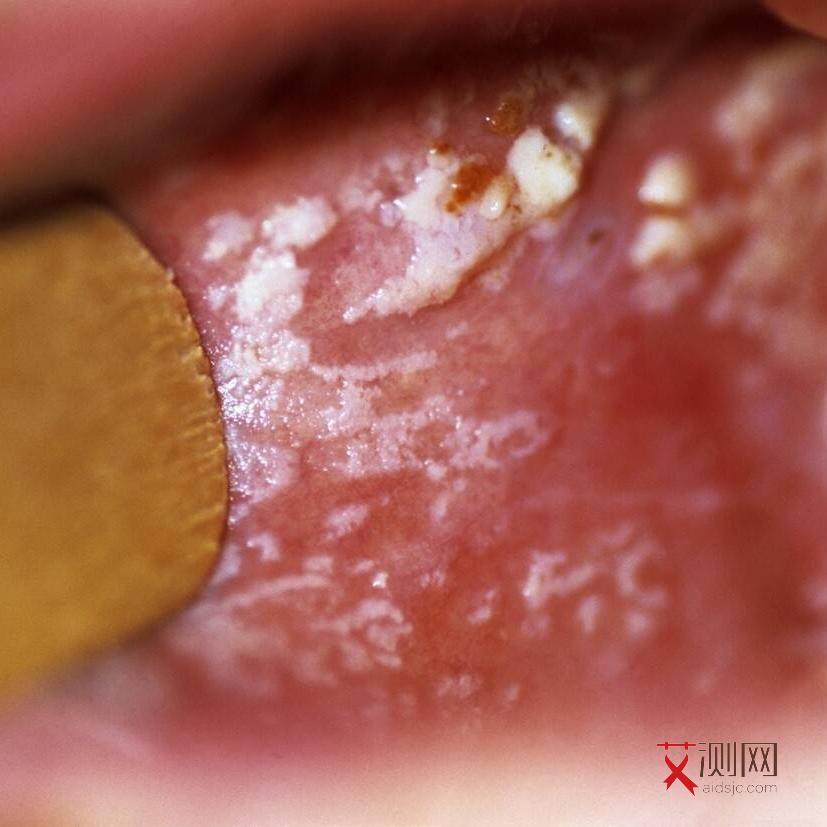 男性怎么判断有没有艾滋病症状表现