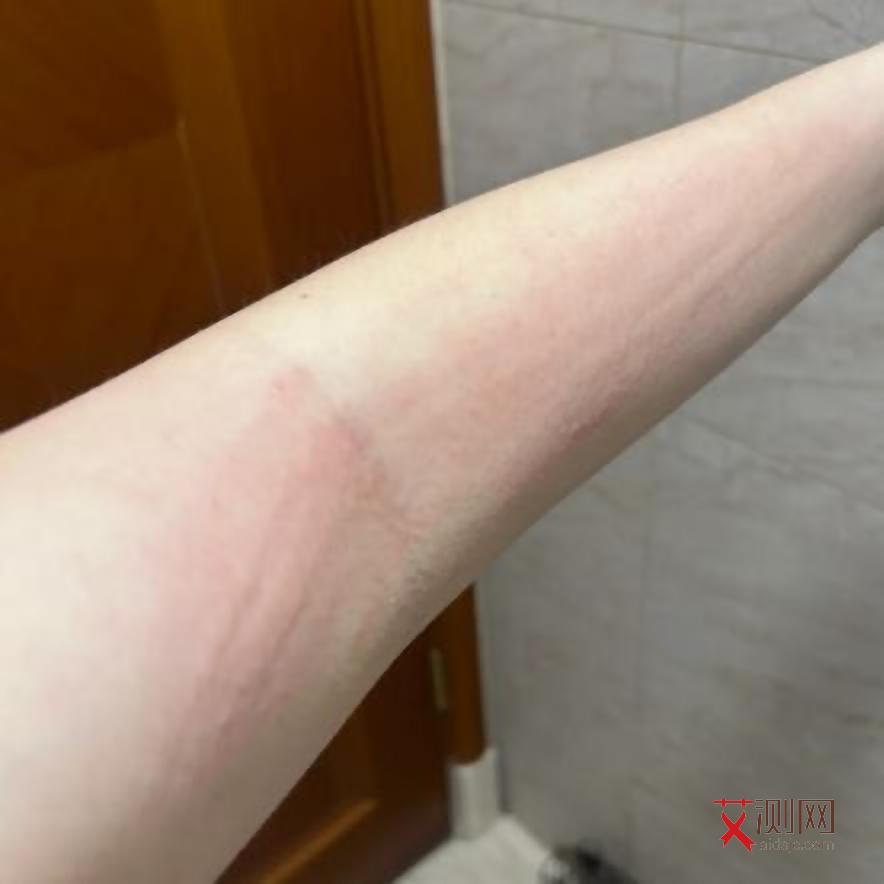 艾滋女性早期症状图表图片