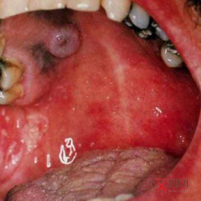 艾滋病症状是单一还是多发的