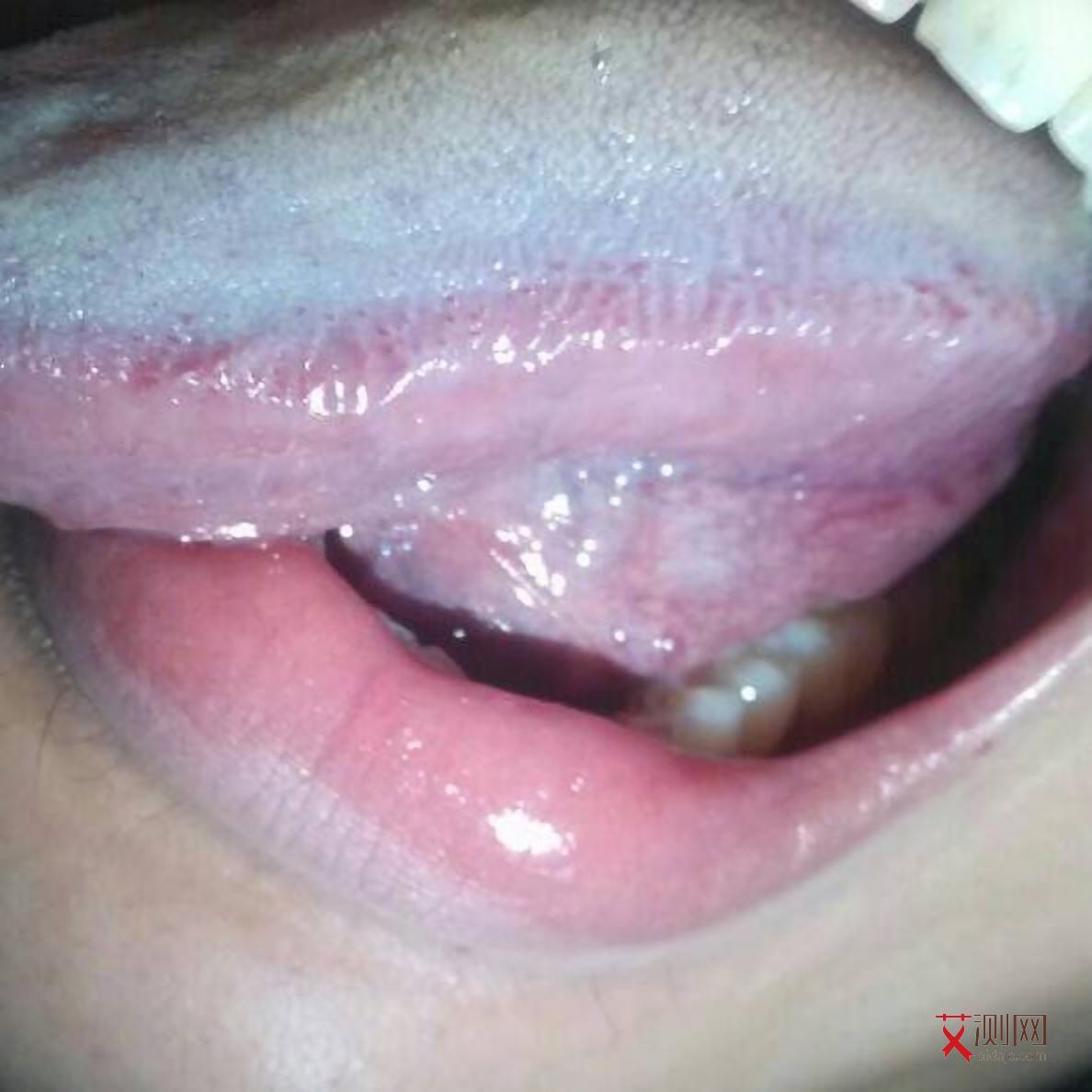 艾滋病感染多久后可以检测出抗体阳性