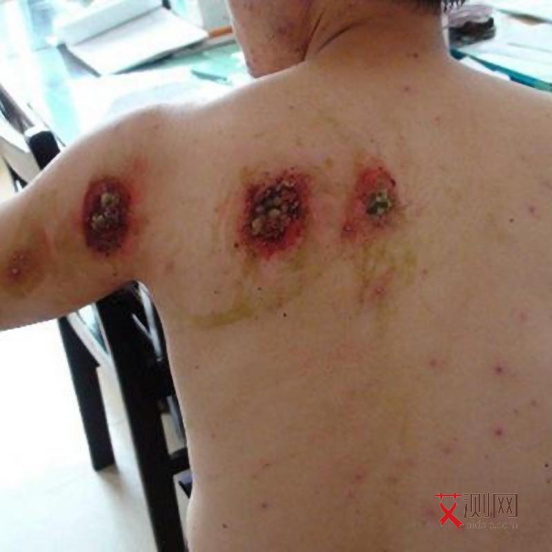 艾滋病初期有哪些症状图片大全男