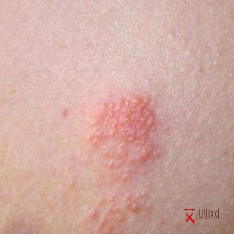 艾滋病多久会出现皮疹症状