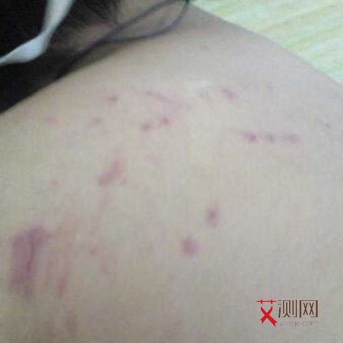 艾滋病有哪些前兆