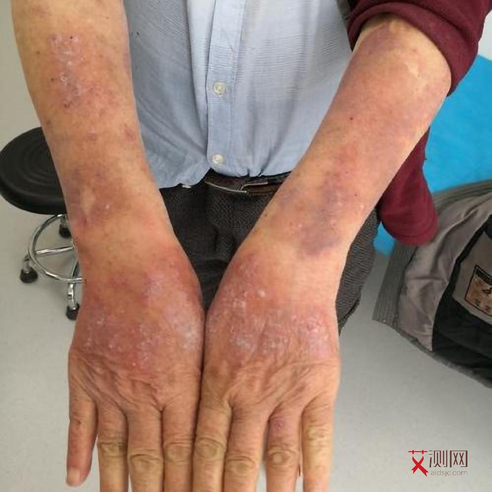 艾滋病初期皮下出血症状