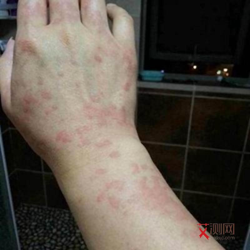 艾滋病小红点会不会流血呢图片