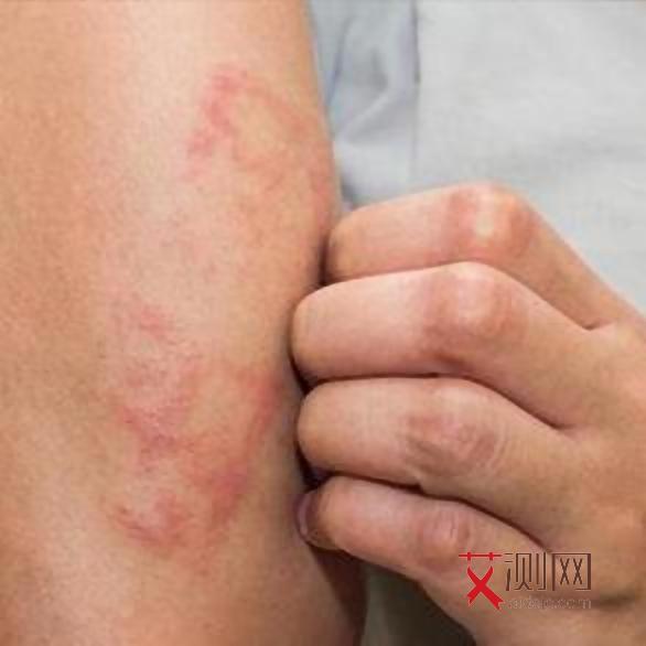 皮肤病和艾滋病的区别图