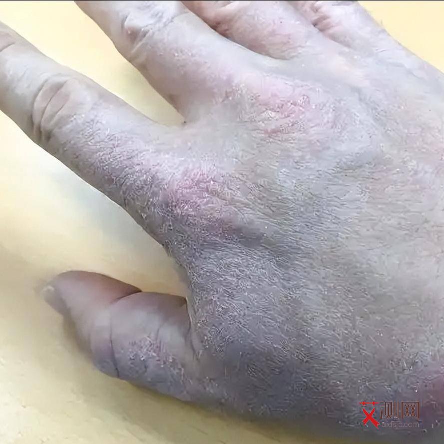 艾滋病的皮肤溃烂会好吗会传染吗女性