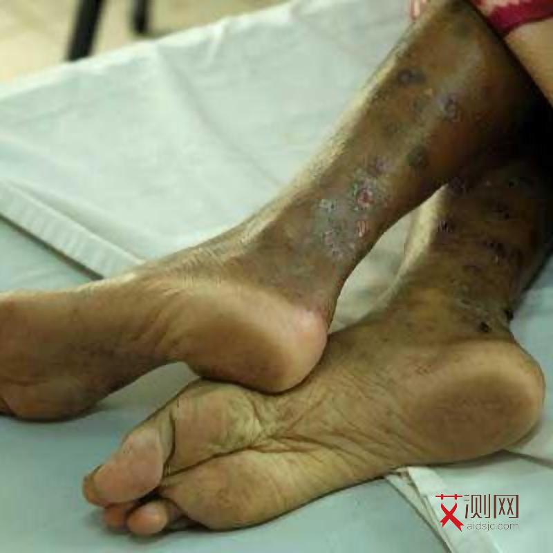 艾滋病的男生有什么异常表现吗