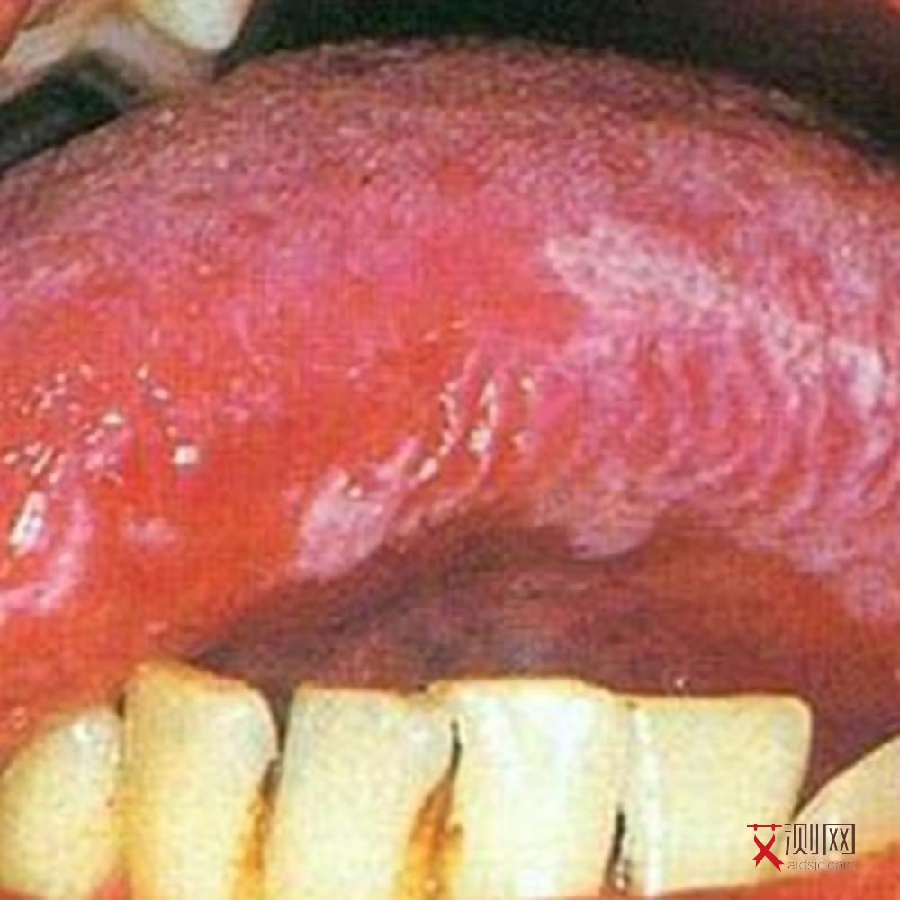 艾滋病吃药发病率高吗