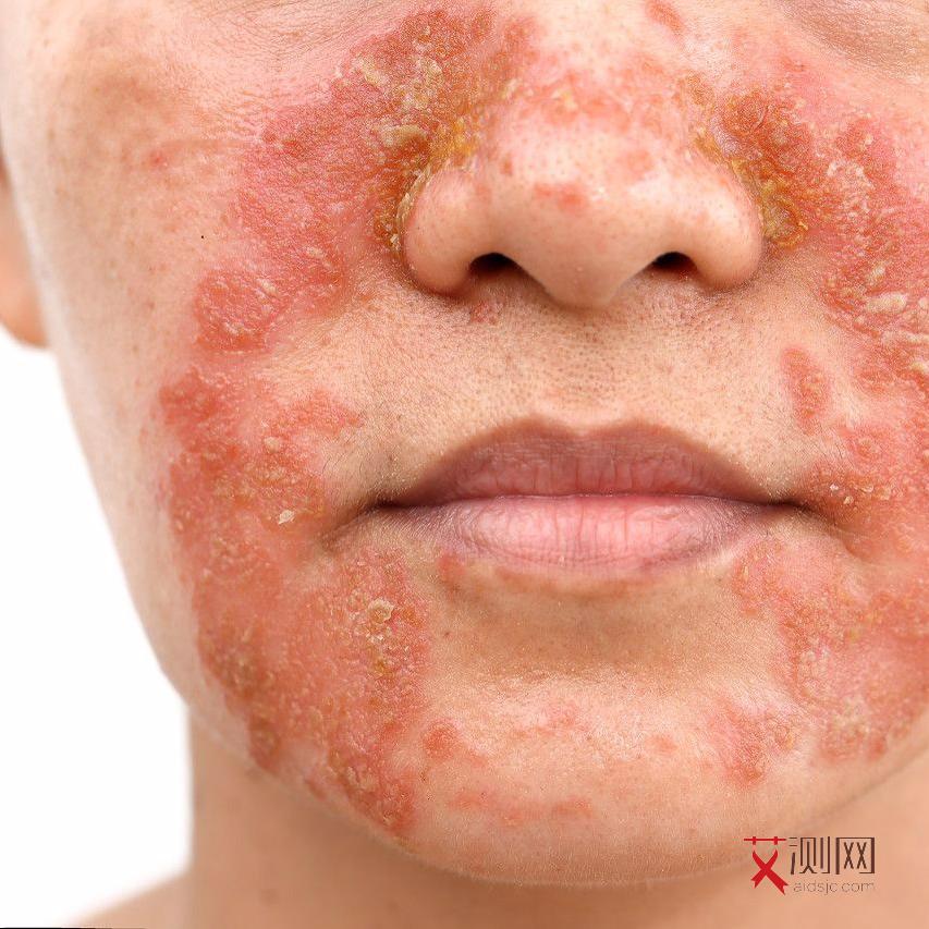 艾滋病一天会有什么症状吗女性