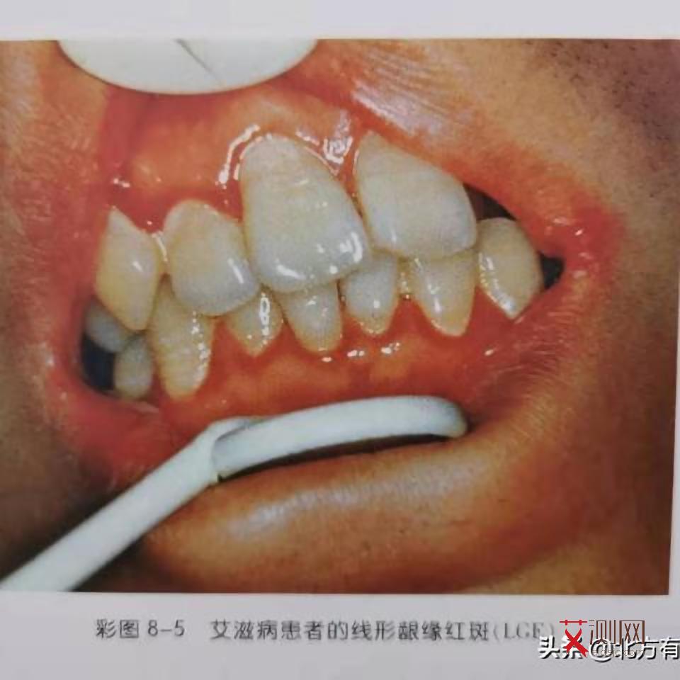 艾滋病多久才发现出来症状