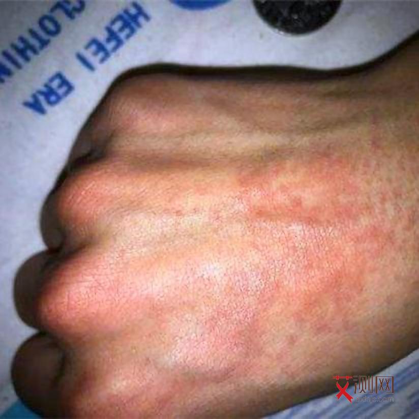 艾滋病初期症状是持续性的吗