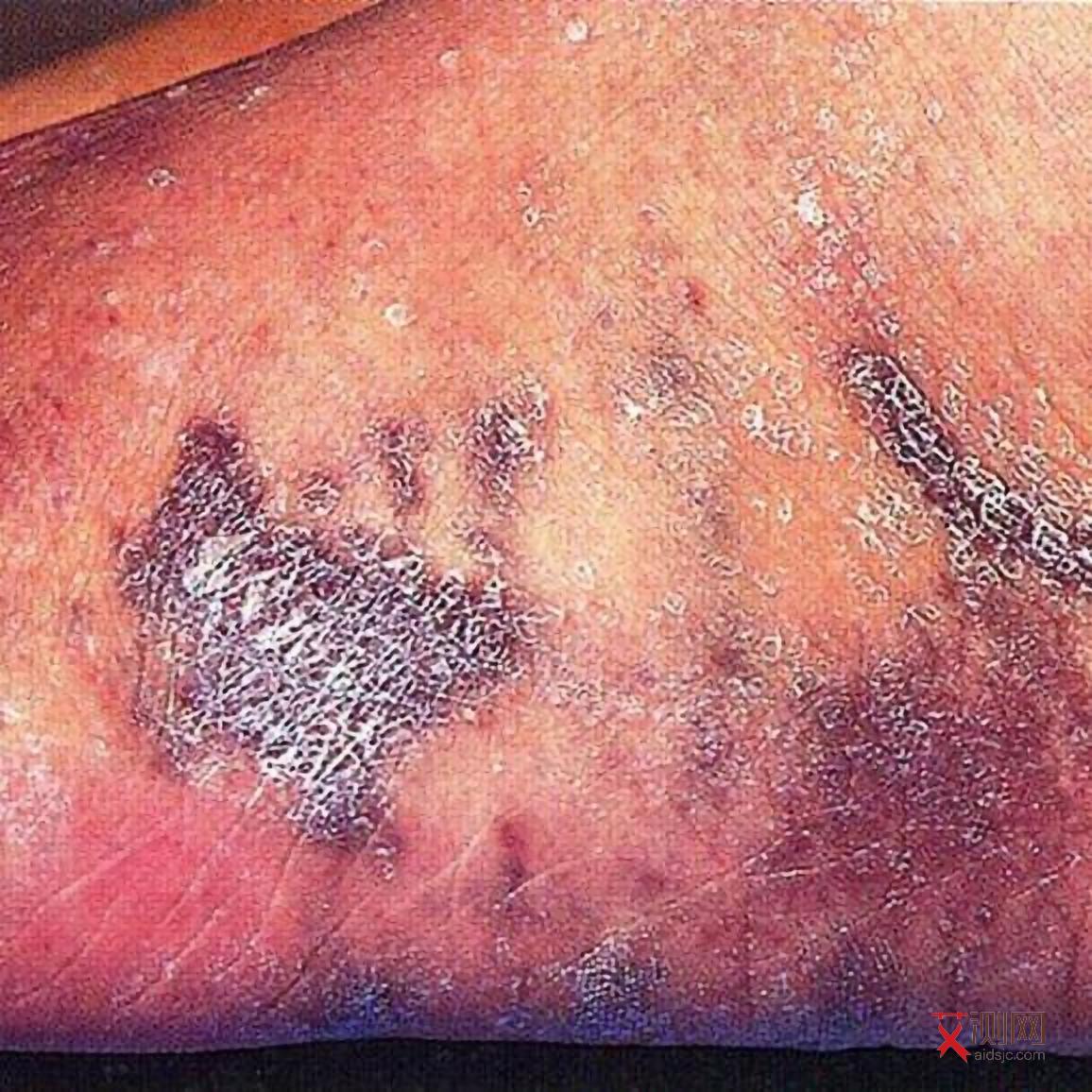 艾滋几天后会出现症状