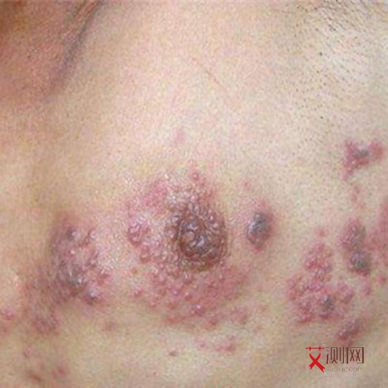 艾滋病口腔溃疡会好吗？