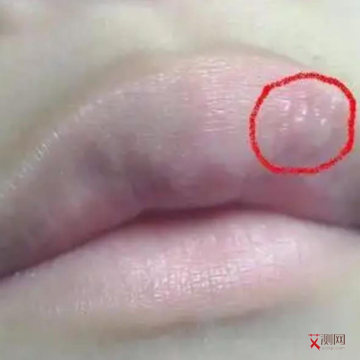 艾滋病初期红疹子图片和症状大全