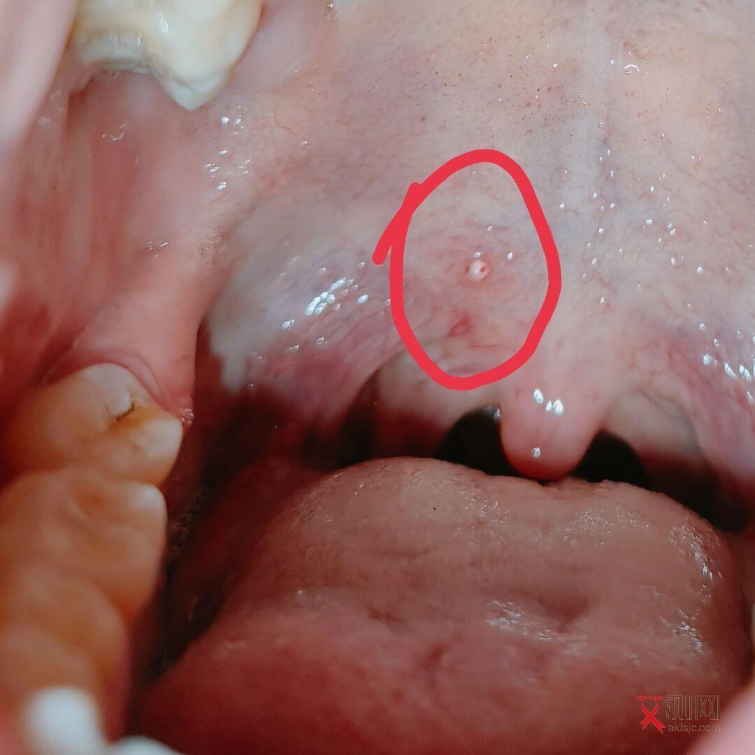 艾滋病患者人数统计