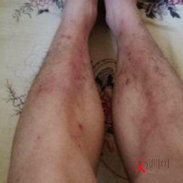 艾滋病前期有什么表现和症状