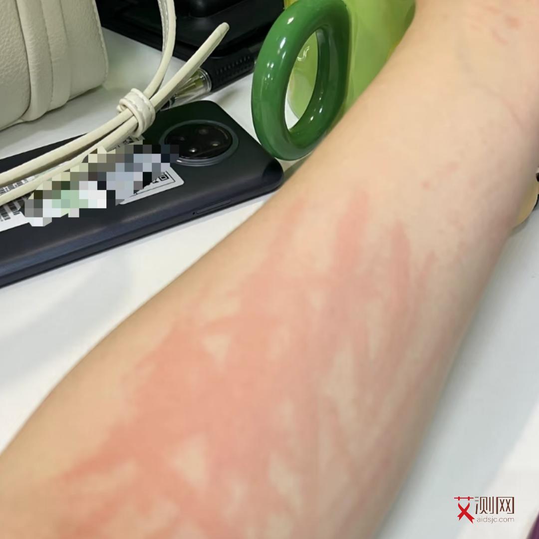 艾滋病多久发作症状