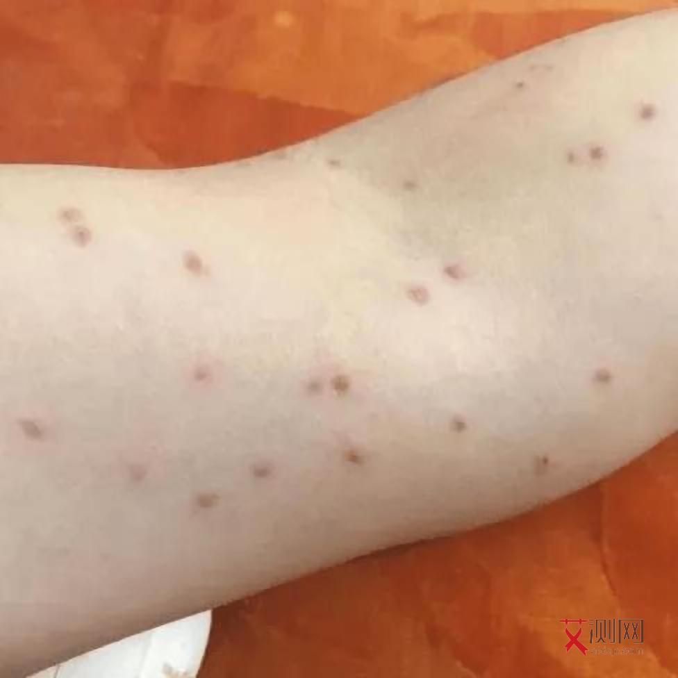 艾滋病患者下体症状图片大全图解