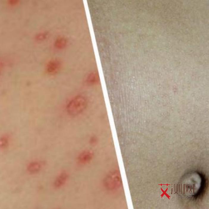 艾滋病初期女性女性生殖器,症状表现有哪些图片