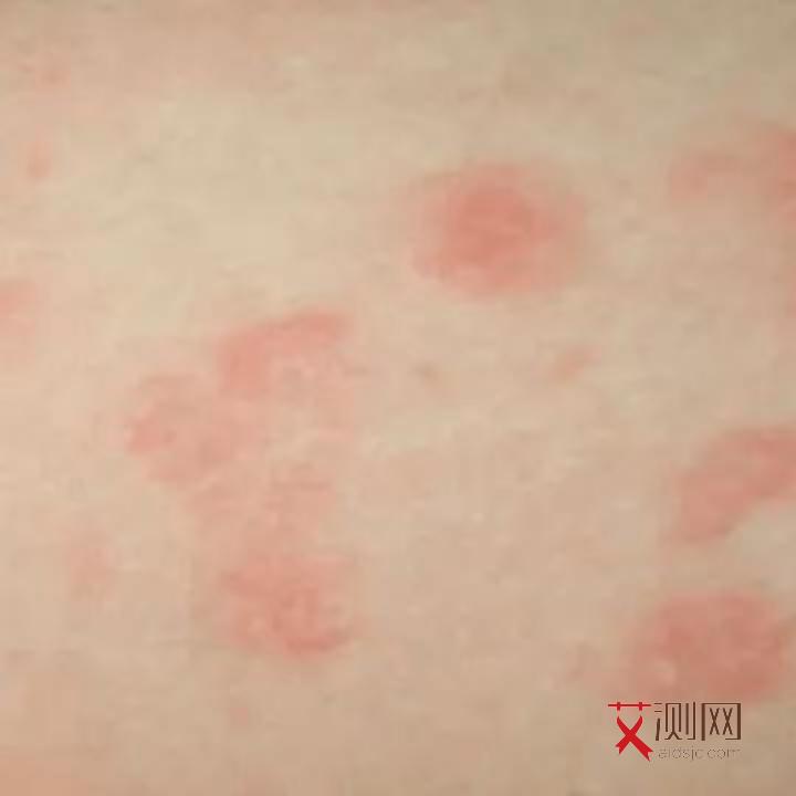 艾滋病患者身上会不会痒呢