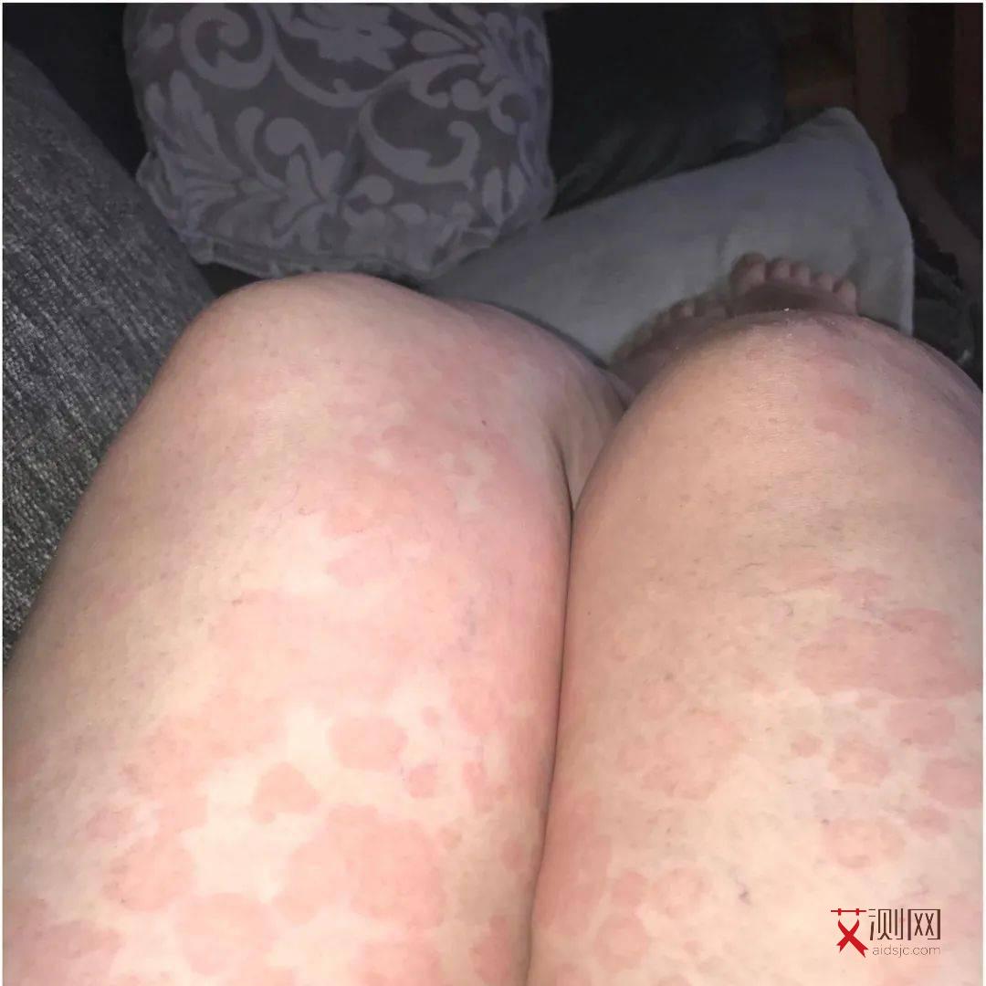 艾滋早期红点点